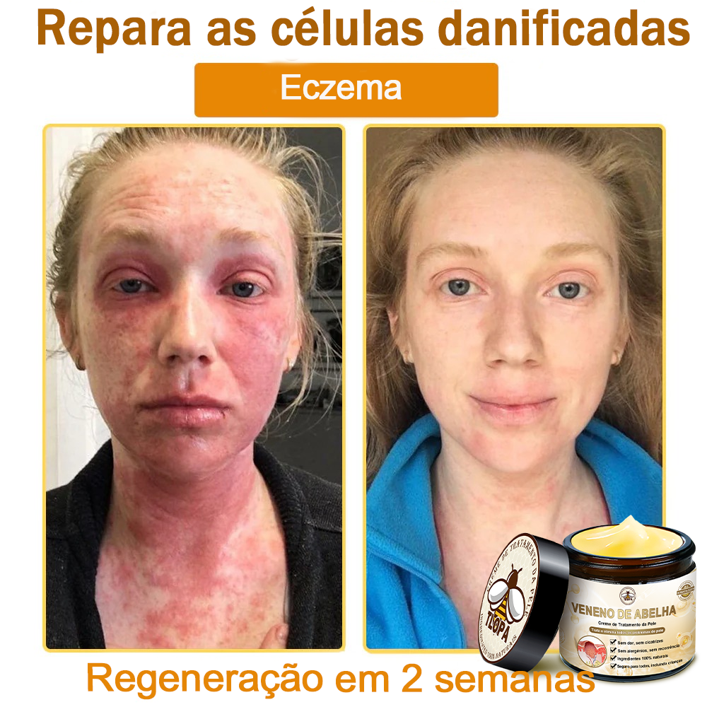 🌿🔥 𝑻𝑳𝑶𝑷𝑨® Creme de Tratamento da Pele com Veneno de Abelha (👨‍⚕️ Com Certificação CE) 👍✅