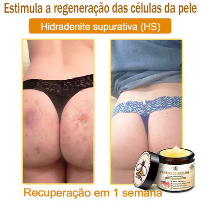 🌿🔥 𝑻𝑳𝑶𝑷𝑨® Creme de Tratamento da Pele com Veneno de Abelha (👨‍⚕️ Com Certificação CE) 👍✅